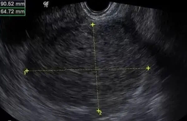 DHA可增加子宫内膜血流灌注
