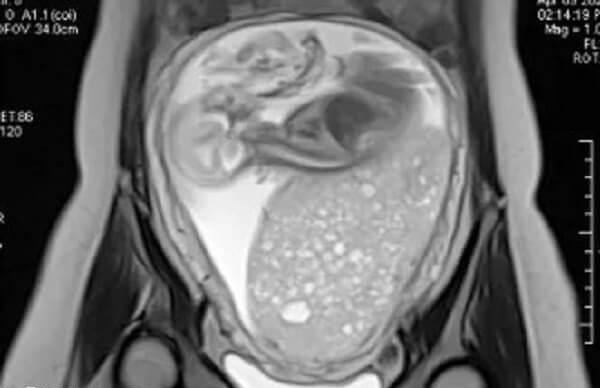 葡萄胎形状类似于葡萄样水泡
