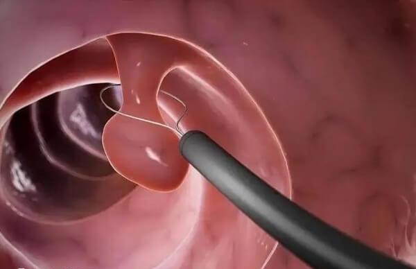 子宫内膜息肉可选择手术