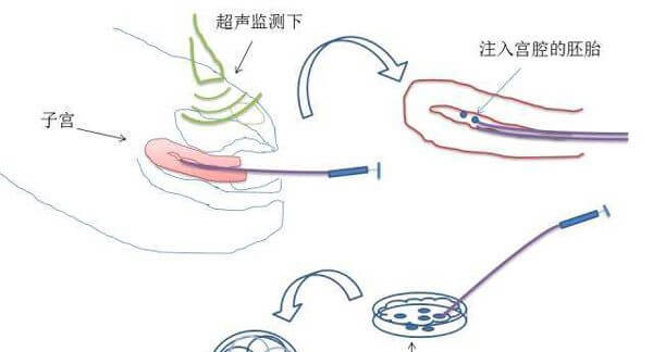 国内试管大多进行鲜胚移植
