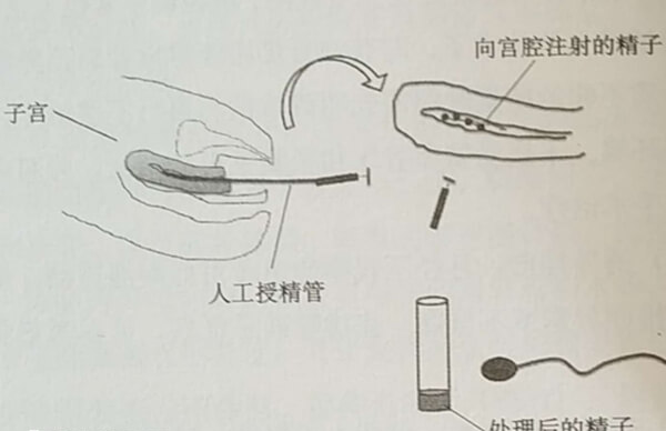 人工授精手术过程
