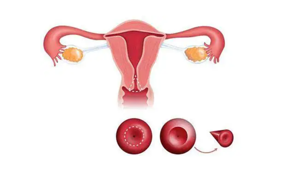 引起女性宫颈性不孕的因素有哪些？宫颈性不孕能治好吗？
