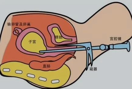 试管婴儿取精少成功率有多高？