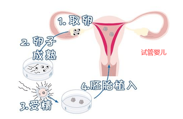 试管婴儿取卵后不受精原因合适哪些患者
