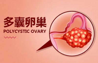 多囊卵巢做试管婴儿：拮抗剂方案为何成为优选？