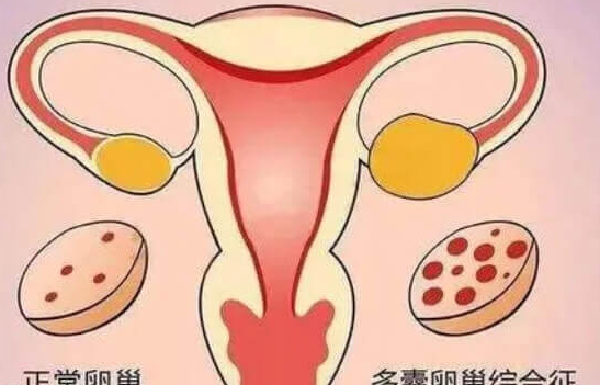多囊卵巢怀孕易胎停：高激素水平或为首因
