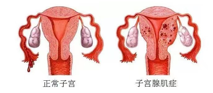 子宫腺肌症患者生育难，试管婴儿能否破局？