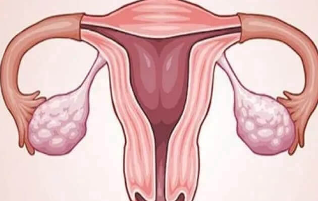 内膜异位做试管婴儿的优缺点：解决难受孕问题是核心优势