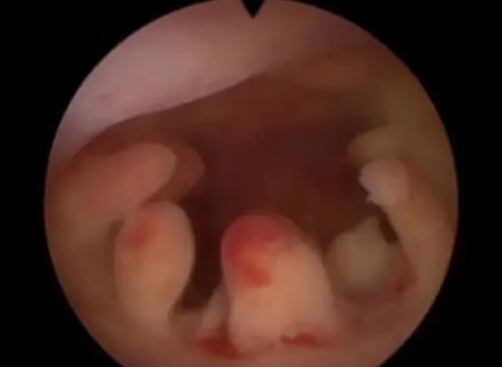 为什么做完宫腔镜要尽快移植？附检查后胚胎移植的时间指南
