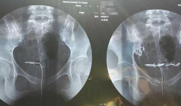 桥本甲状腺炎患者做试管婴儿造影:可行性与关键禁忌 桥本甲状腺炎患者做试管婴儿造影:可行性与关键禁忌