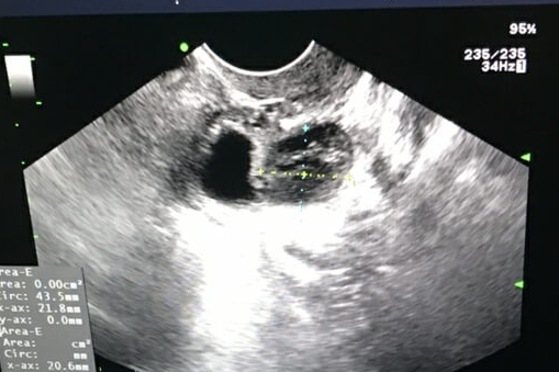 试管婴儿期间B超检查注意事项：要不要憋尿看完便知