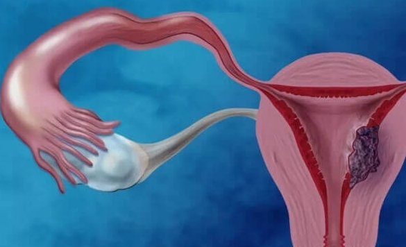 多囊患者试管婴儿前调理指南:优质蛋白助力成功率提升