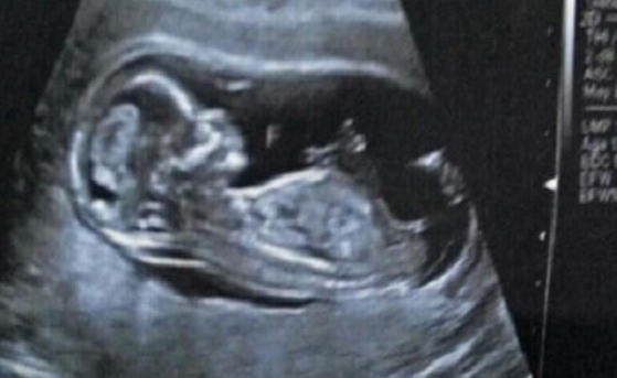 试管婴儿不能直接预防脊柱侧弯!弄清两者关系是关键