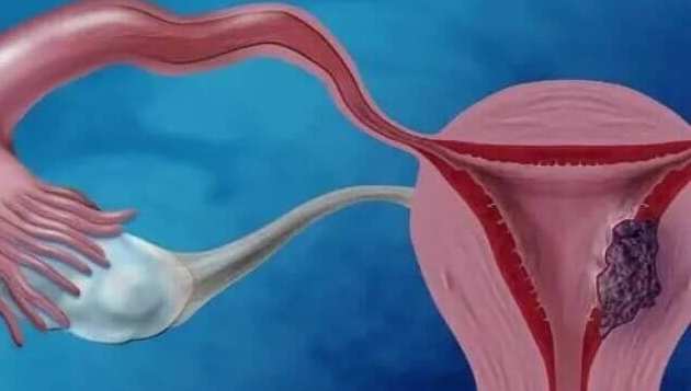 女性宫腔粘连的治疗方法:药物治疗与手术治疗全解析