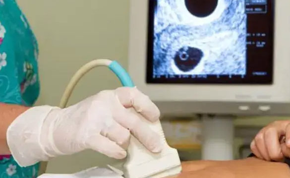 输卵管堵塞做试管婴儿：宫外孕风险与疏通治疗的必要性