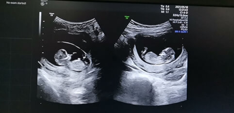 移植双胚，双胞胎并非“板上钉钉”