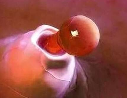 泰国三代试管婴儿需要做羊穿吗？深度解析与全面探讨