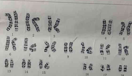 美国试管胚胎染色体16三体原因分析
