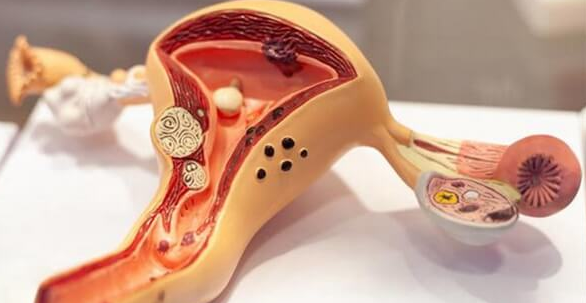 子宫肌瘤女性的饮食禁忌：蜂王浆、大豆需谨慎