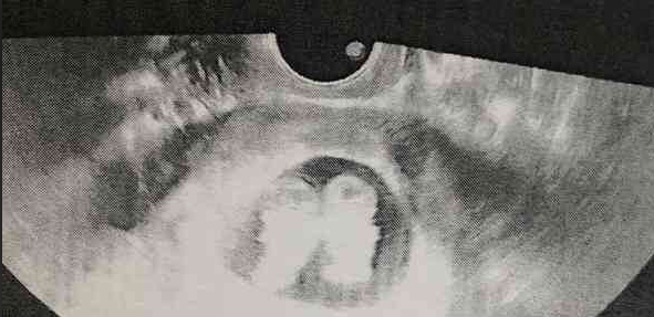 男性肺结核患者能否做试管婴儿?影响与注意事项全解析