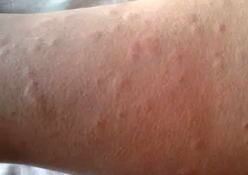 荨麻疹会影响胚胎着床！美国试管婴儿期间出现荨麻疹怎么办？