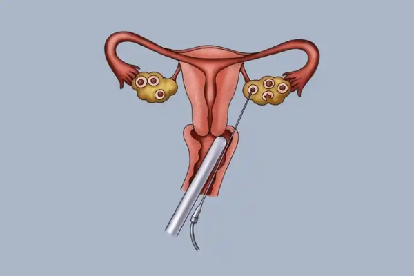 泰国千禧生殖中心：试管婴儿哪个环节最“疼”？促排与取卵深度解析