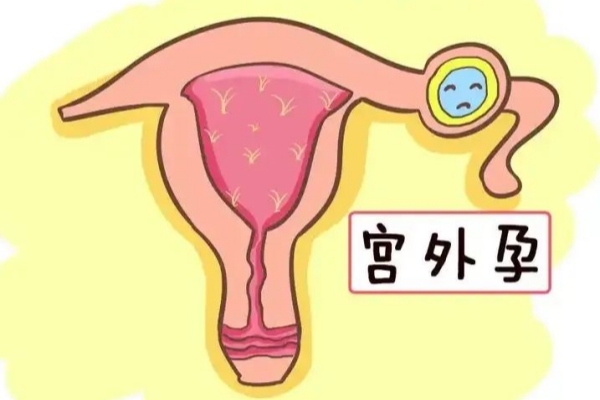 美国EFC生殖中心：做试管婴儿还有宫外孕风险？