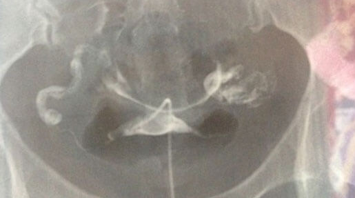 上海试管婴儿医院：双侧排卵可能会生双胞胎！具体得看受孕时机等3大因素