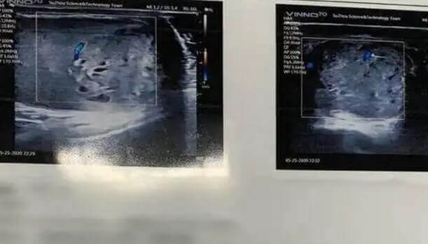 子宫内膜薄在美国做试管移植能否成功？