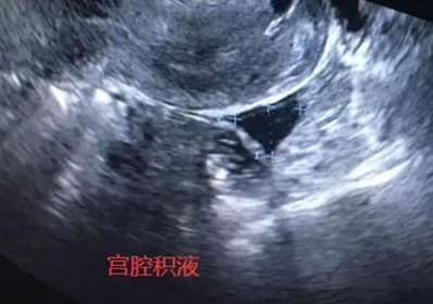 为什么泰国做试管婴儿容易宫腔积液？