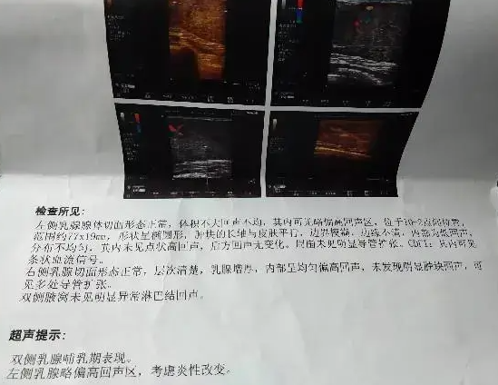 上海试管婴儿医院：乳腺结节三类能否做试管婴儿？直径1厘米内需密切随访