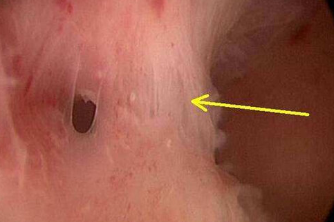 上海试管婴儿医院：宫腔粘连做试管婴儿选对冻胚移植时间是关键