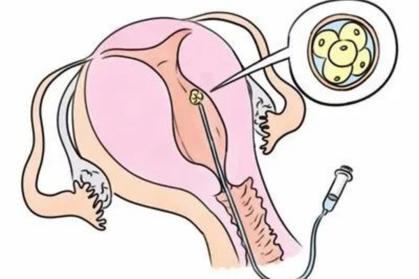 美国EFC生殖中心：自然怀孕与试管促排-大龄备孕女性的“避坑”指南