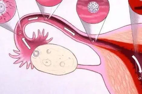 多囊促排成功不受孕的原因：输卵管堵塞为何成首要因素？
