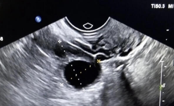 38岁女性促排取卵数量：卵巢功能是关键变量