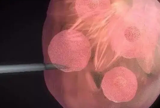 取卵手术对女性的潜在风险:不可忽视的健康警示