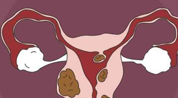 腺肌症最新生育指南：注意事项与怀孕影响速览
