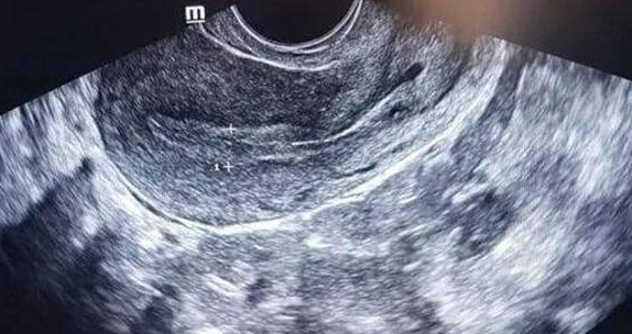 做试管提高着床的秘诀：调整子宫内膜状态是关键