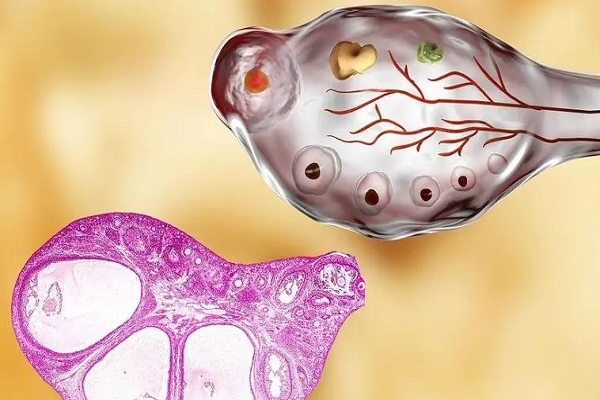 美国CCRH生殖中心：AMH值低但基础卵泡多背后的原因
