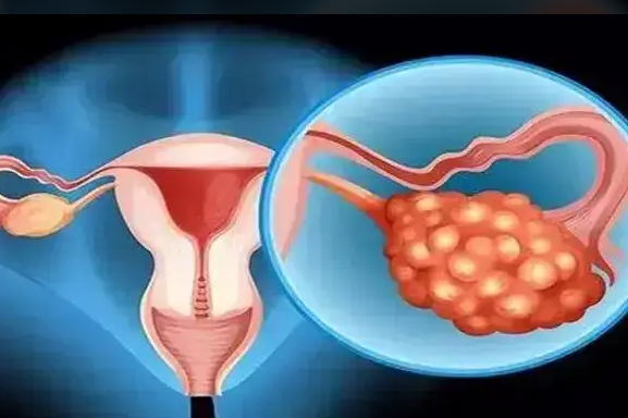 卵巢囊肿美国试管婴儿成功率预估：两大影响真实存在