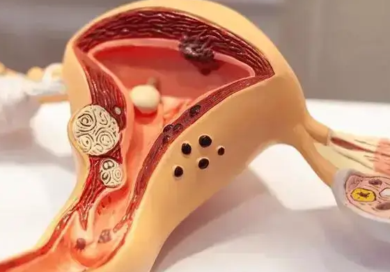 弓形子宫与试管婴儿:科学应对子宫畸形,提升妊娠成功率