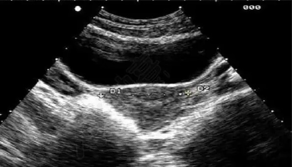 降低泰国试管婴儿妊娠率的疾病盘点