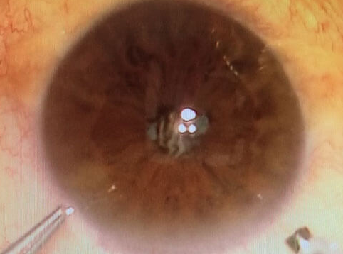 角膜营养不良会遗传，有必要做三代试管婴儿吗？