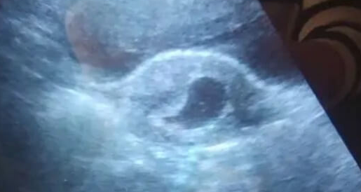 泰国试管后孕囊偏小别焦虑，科学补救有方法