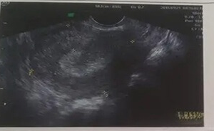 做试管婴儿打了降调针，子宫内膜会变薄吗？一文告知