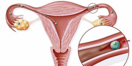 做试管婴儿有必要检查输卵管!积水对成功率影响大