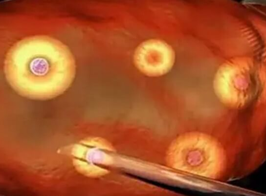 泰国做试管婴儿初次检查流程详解