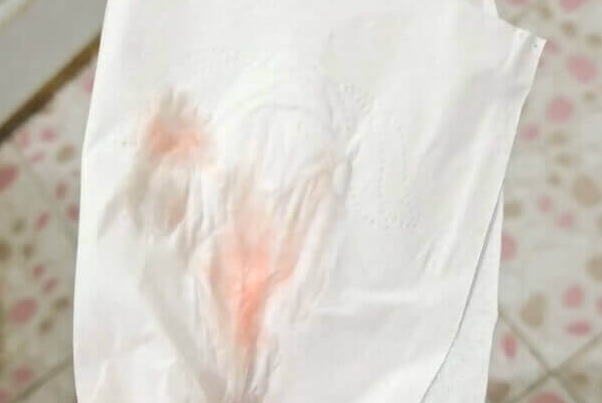 山东大学附属生殖医院：试管移植后有血丝的原因分析及正常与否判断