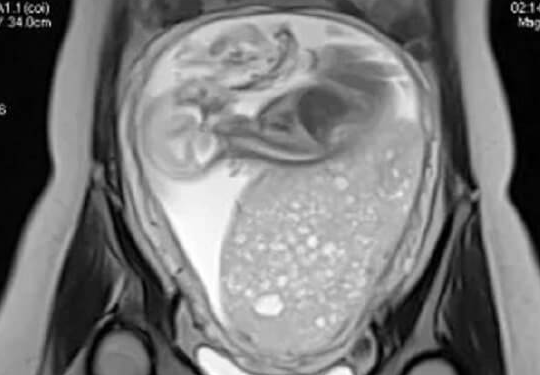 试管婴儿促排期 B 超在用药精准调控中的关键作用