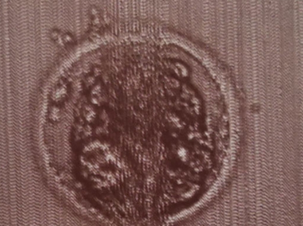 杭州试管婴儿：囊胚培养的利弊深度剖析